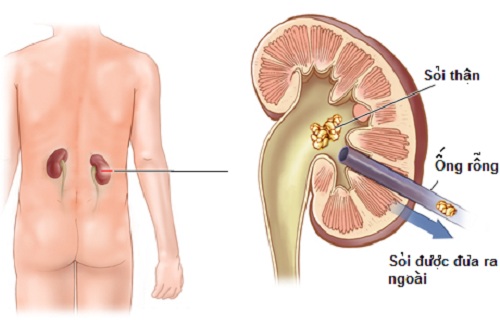 Bệnh sỏi thận