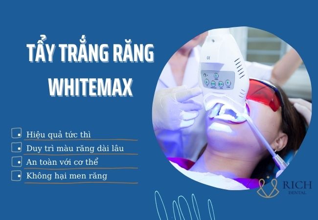 chi phí tẩy trắng răng