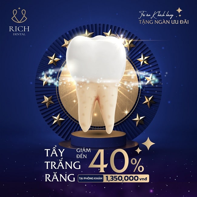 chi phí tẩy trắng răng